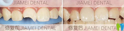 佳美口腔牙齒修復(fù)案例