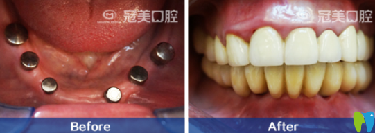 北京冠美口腔王希奇院長種植牙前后效果對比圖