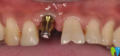 嘉和口腔即刻種植牙過(guò)程圖