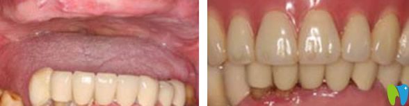 深圳韋博口腔半口牙缺失種植效果案例 深圳韋博口腔半口牙缺失種植效果案例
