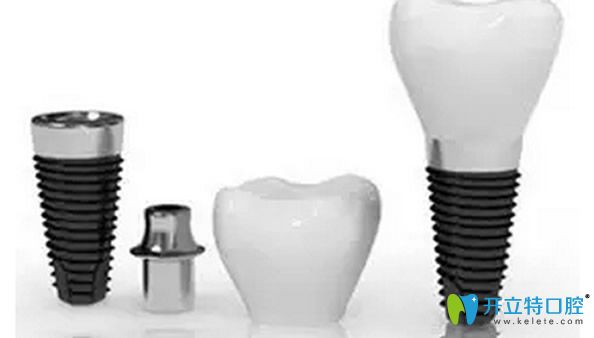 種植體及種植系統(tǒng)的選擇是影響種植牙壽命的重要因素