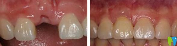 單顆門牙缺失在韋博口腔的種植效果 單顆門牙缺失在韋博口腔的種植效果