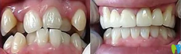 深圳韋博口腔矯正牙齒前后效果對比圖 深圳韋博口腔矯正牙齒前后效果對比圖