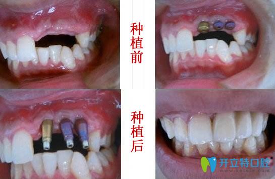 <!--<i data=20240703-sp></i>-->圣貝王申院長多顆牙缺失即刻種植前后對比照 <!--<i data=20240703-sp></i>-->圣貝王申院長多顆牙缺失即刻種植前后對比照