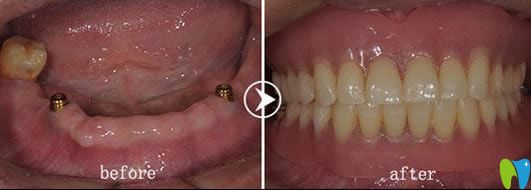 <!--<i data=20240703-sp></i>-->圣貝王申醫(yī)生全口all on 4種植牙前后對比效果 <!--<i data=20240703-sp></i>-->圣貝王申醫(yī)生全口all on 4種植牙前后對比效果