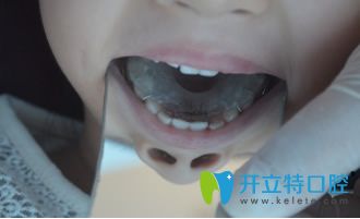 重慶德亞口腔乳牙反頜矯正戴頜墊推簧第1天 重慶德亞口腔乳牙反頜矯正戴頜墊推簧第1天