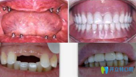 鄭建偉全口牙缺失種植案例+多顆牙缺失種植案例