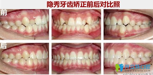 隱秀牙齒矯正前后對比