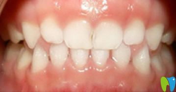 美奧齒科隱形矯正牙齒18個月效果