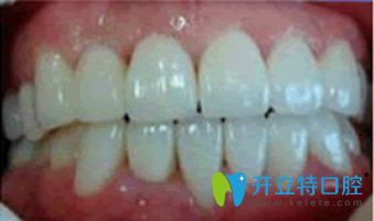 杭牙牙齒隱形正畸一年后效果