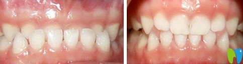 <!--<i data=20240703-sp></i>-->美奧矯正牙齒前后效果對比圖