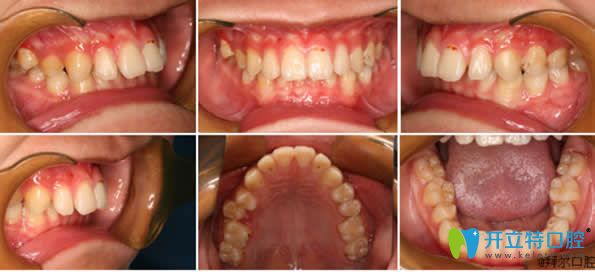 <!--<i data=20240703-sp></i>-->拜博口腔矯正牙齒前 <!--<i data=20240703-sp></i>-->拜博口腔矯正牙齒前
