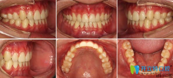 <!--<i data=20240703-sp></i>-->拜博口腔牙齒矯正2年后的恢復(fù)效果 <!--<i data=20240703-sp></i>-->拜博口腔牙齒矯正2年后的恢復(fù)效果