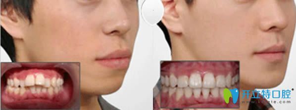 北京美年牙科齙牙前突矯正后對(duì)比圖