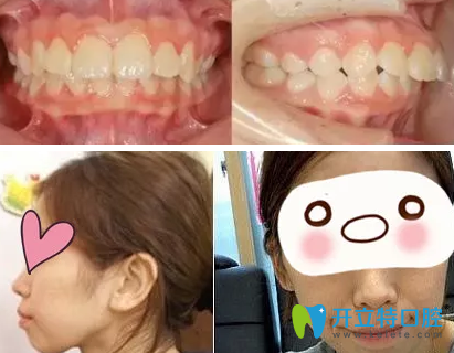 上?？泼揽谇辉趺礃?？看了我28歲牙齒矯正前后照片真是后悔