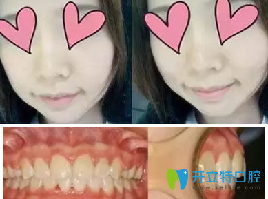 我在<!--<i data=20240703-sp></i>-->科美口腔做隱形牙齒矯正一年的效果