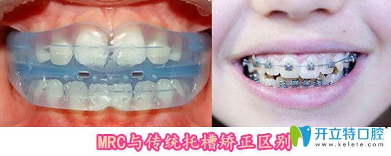 MRC與傳統(tǒng)托槽矯正區(qū)別