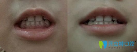 <!--<i data=20240703-sp></i>-->口腔3歲女童牙齒矯正1個月后照片