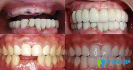 鄭州卓 越口腔牙齒種植效果圖 鄭州卓 越口腔牙齒種植效果圖