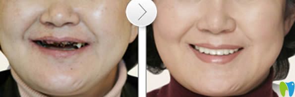 老年人全口牙種植前后對(duì)比<span style=