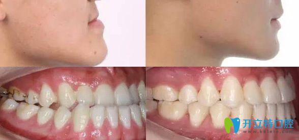 維樂(lè)口腔牙齒矯正前后效果對(duì)比