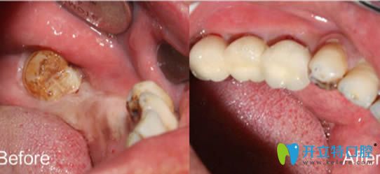 <!--<i data=20240703-sp></i>-->永華口腔種植牙前后對(duì)比照