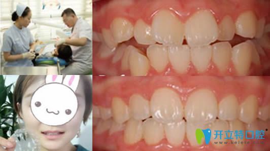<!--<i data=20240703-sp></i>-->永華口腔隱形牙齒矯正效果對比圖