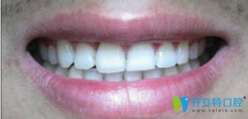 隱形無托槽牙齒矯正后的效果