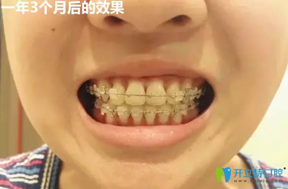做完金屬托槽牙齒矯正一年三個月效果