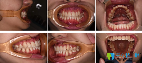 鄭州拜博口腔正畸效果案例