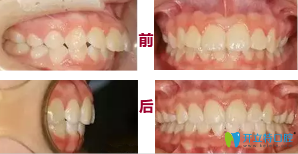 太原眾牙口腔牙齒矯正前后對(duì)比圖