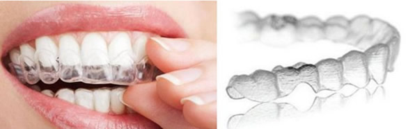 哪些人不適合戴隱形牙套 牙套的種類、價格及優(yōu)劣勢大比拼