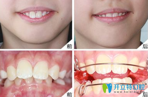 樸雄希兒童門牙前突矯正案例