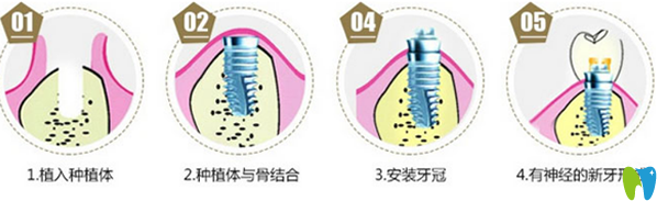 種植牙過程