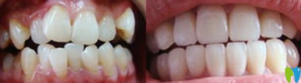 瑞安口腔牙齒矯正代表案例 瑞安口腔牙齒矯正代表案例