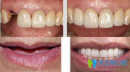 拜博口腔李紹軍院長(zhǎng)種植牙案例