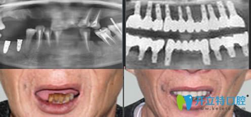 重慶皇仕口腔半口牙種植效果圖 重慶皇仕口腔半口牙種植效果圖