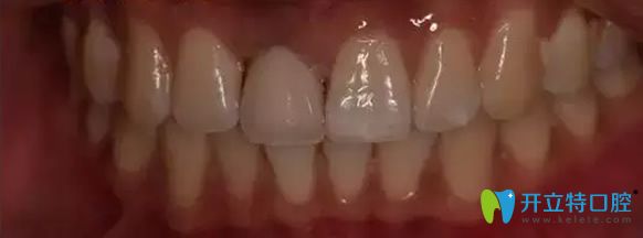 北京永康口腔門牙缺失修復(fù)后效果