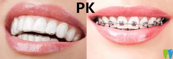 隱形矯正VS傳統(tǒng)牙套哪種效果？有什么區(qū)別呢？