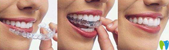 隱形矯正可以自由取戴