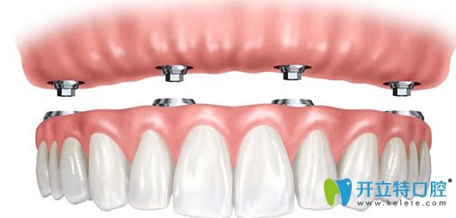 永康口腔黃世宇院長為王大媽設(shè)計(jì)的診療方案