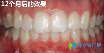 在<!--<i data=20240703-sp></i>-->馬瀧齒科做完隱適美牙齒矯正12個月的效果 在<!--<i data=20240703-sp></i>-->馬瀧齒科做完隱適美牙齒矯正12個月的效果