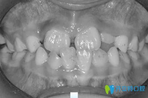 7歲兒子地包天沒有在成都金琴口腔做矯正前樣子 7歲兒子地包天沒有在成都金琴口腔做矯正前樣子