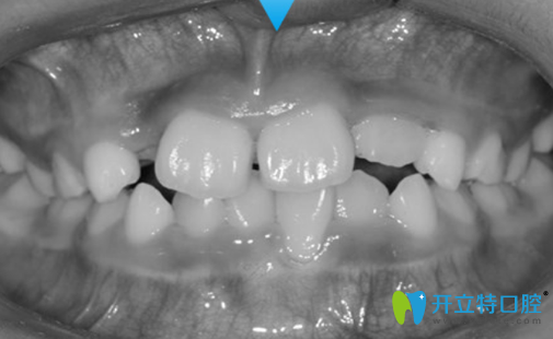 在成都金琴口腔找許楨睿做兒童反頜矯正半年后 在成都金琴口腔找許楨睿做兒童反頜矯正半年后