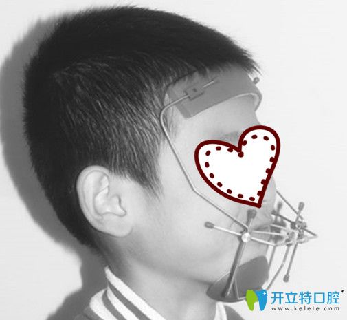 兒子戴頜前方牽引矯正裝置的照片 兒子戴頜前方牽引矯正裝置的照片