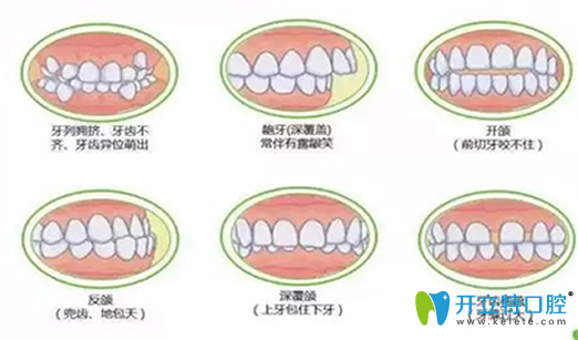 深度揭秘：在做牙齒矯正之前，你不得不了解的17個(gè)問題