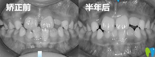 成都金琴口腔兒子地包天矯正前后<span style= 成都金琴口腔兒子地包天矯正前后<span style=