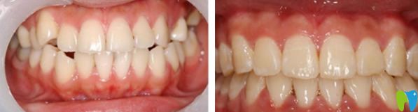 瑞爾口腔牙齒矯正前后效果圖 瑞爾口腔牙齒矯正前后效果圖