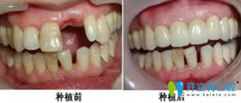 鄭州精益口腔種植牙前后效果對比圖