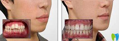 鄭州精益口腔牙齒矯正前后效果對比圖